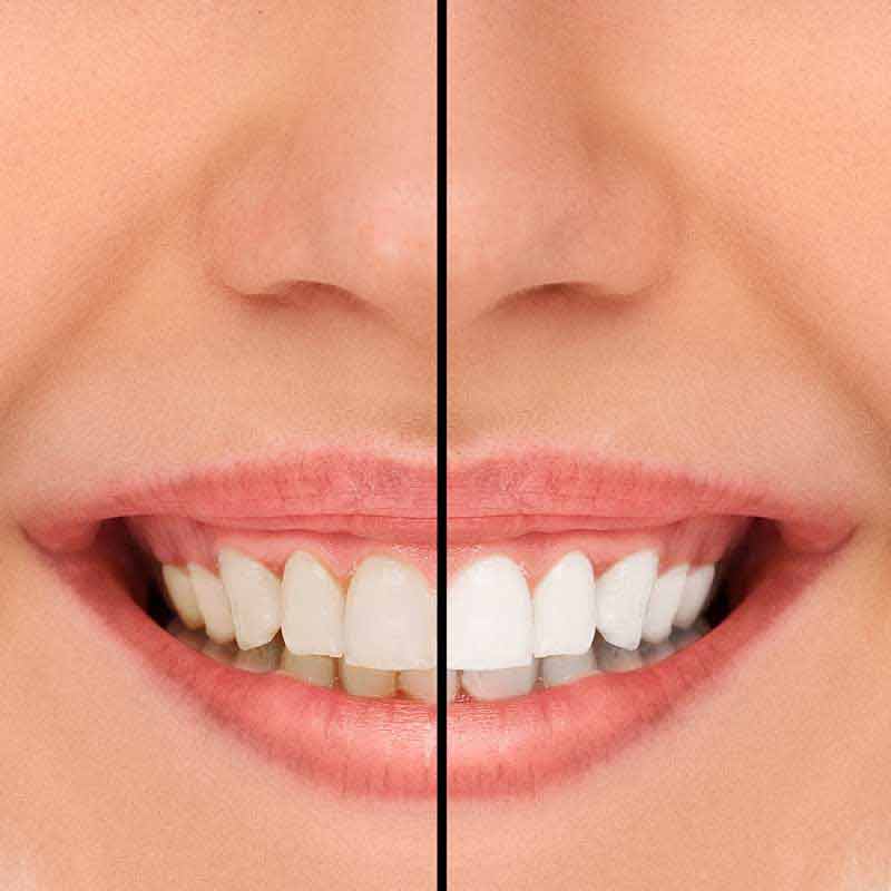 عکس با کیفیت از دندان های سالم